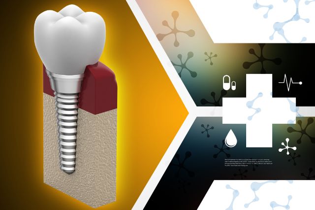 what-are-the-stages-of-dental-implants